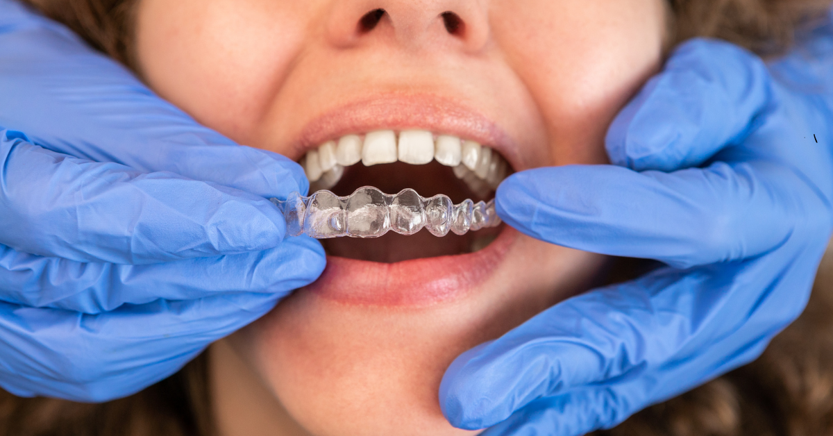 Invisalign Treatment