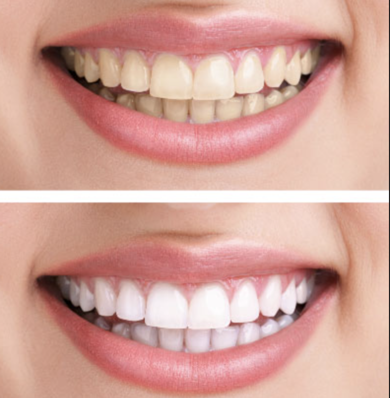 zoom teeth whitening